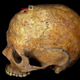 The evidence of trepanation.